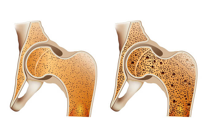 imagem de osteoporose